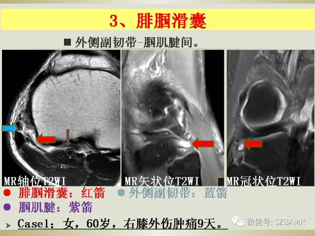 【PPT】膝关节滑囊影像解剖与病变