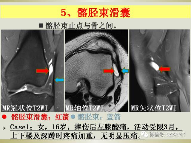 【PPT】膝关节滑囊影像解剖与病变