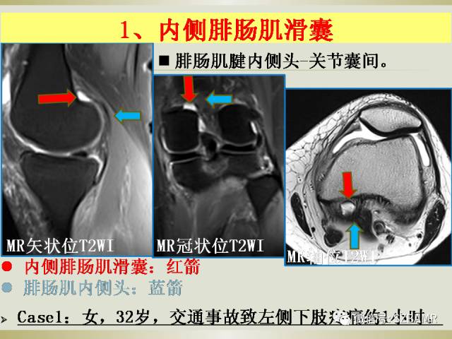 【PPT】膝关节滑囊影像解剖与病变