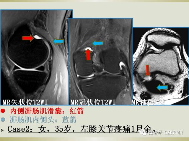 【PPT】膝关节滑囊影像解剖与病变
