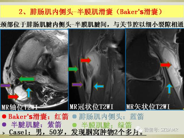 【PPT】膝关节滑囊影像解剖与病变