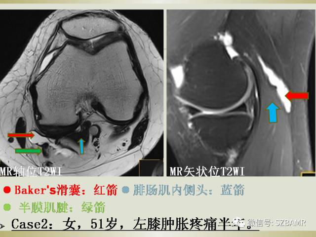 【PPT】膝关节滑囊影像解剖与病变