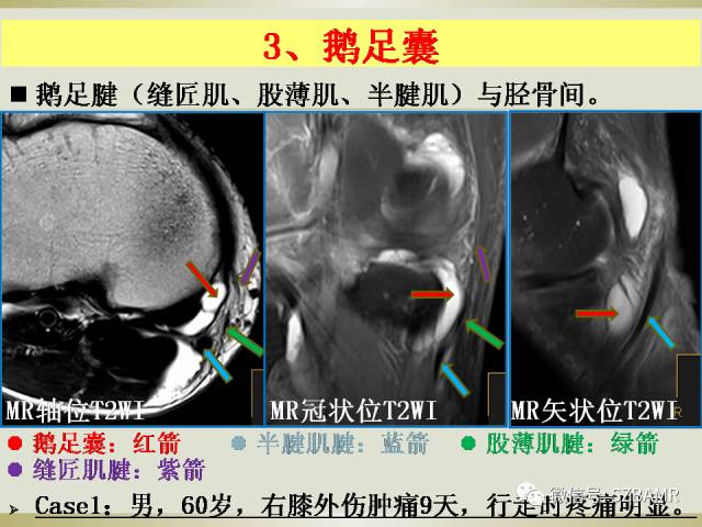 【PPT】膝关节滑囊影像解剖与病变