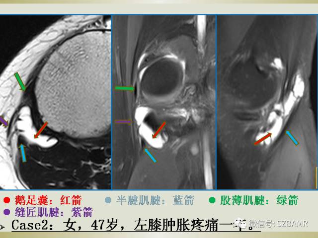【PPT】膝关节滑囊影像解剖与病变