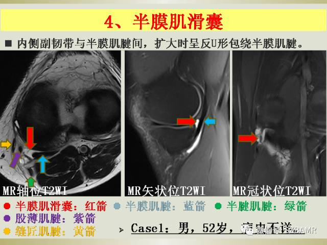 【PPT】膝关节滑囊影像解剖与病变