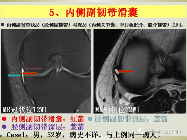 【PPT】膝关节滑囊影像解剖与病变