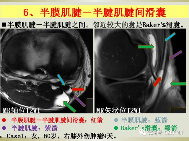 【PPT】膝关节滑囊影像解剖与病变