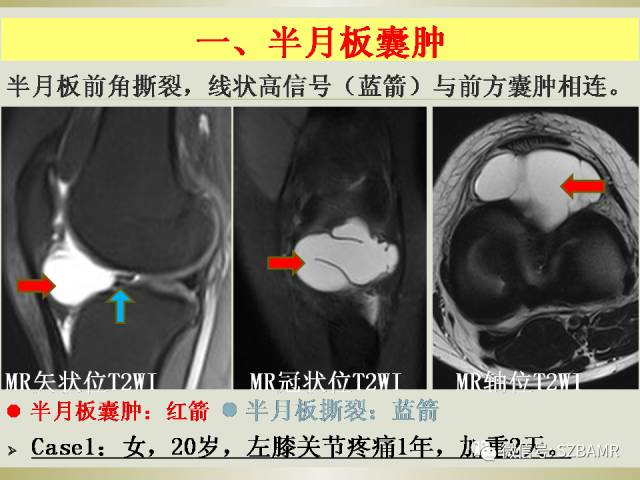 【PPT】膝关节滑囊影像解剖与病变
