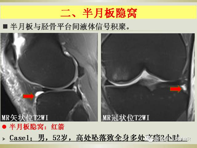 【PPT】膝关节滑囊影像解剖与病变