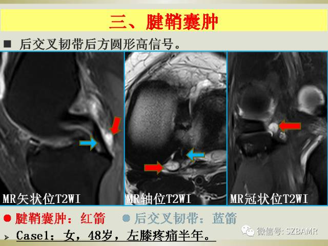 【PPT】膝关节滑囊影像解剖与病变