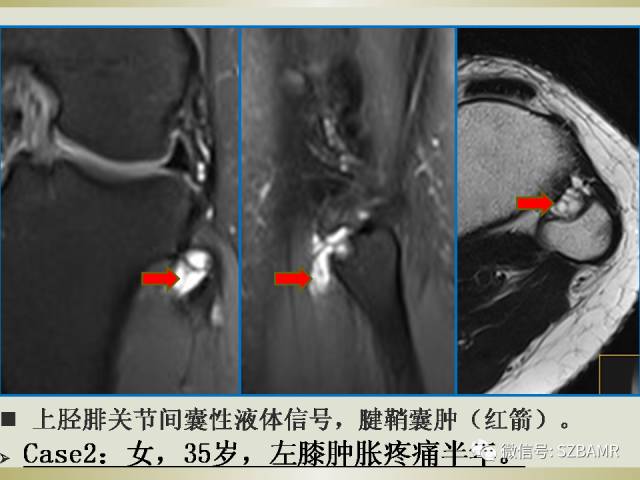 【PPT】膝关节滑囊影像解剖与病变