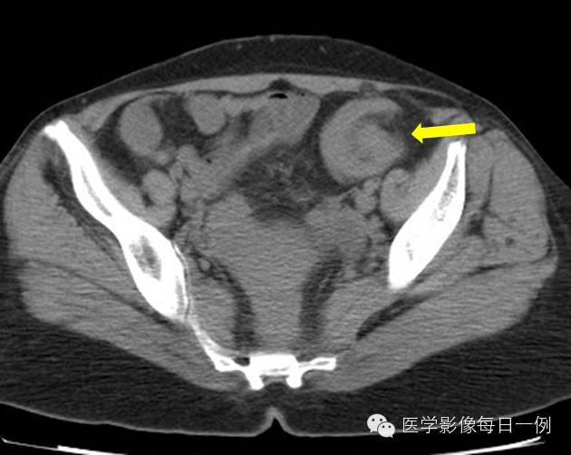 【病例】乙状结肠脂肪瘤并肠套叠1例CT影像表现