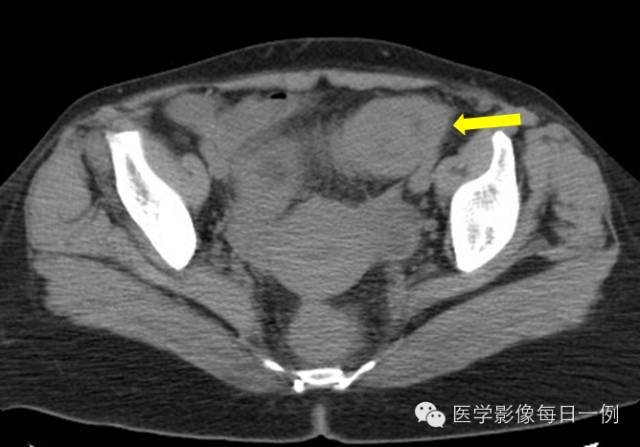 【病例】乙状结肠脂肪瘤并肠套叠1例CT影像表现 【病例】乙状结肠脂肪瘤并肠套叠1例CT影像表现