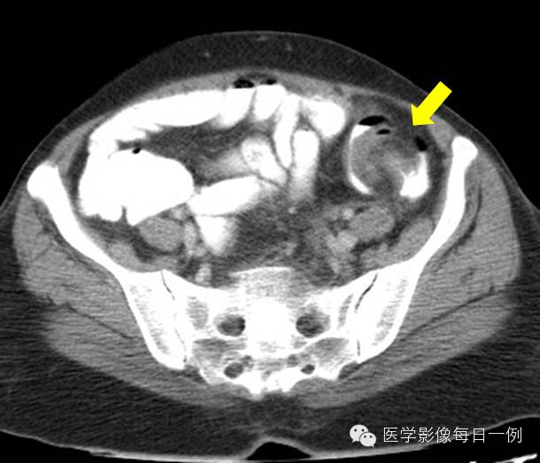 【病例】乙状结肠脂肪瘤并肠套叠1例CT影像表现 【病例】乙状结肠脂肪瘤并肠套叠1例CT影像表现