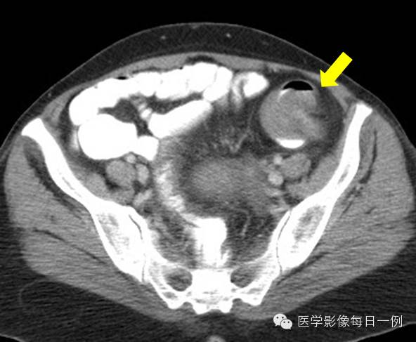 【病例】乙状结肠脂肪瘤并肠套叠1例CT影像表现 【病例】乙状结肠脂肪瘤并肠套叠1例CT影像表现
