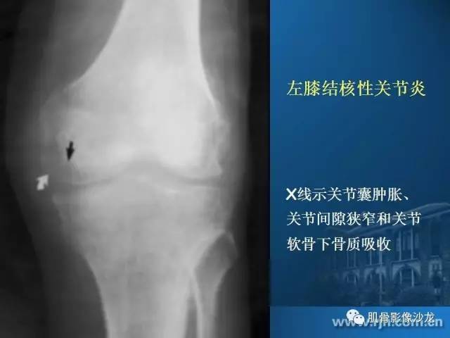 【PPT】磁共振软骨成像与骨关节炎治疗评价