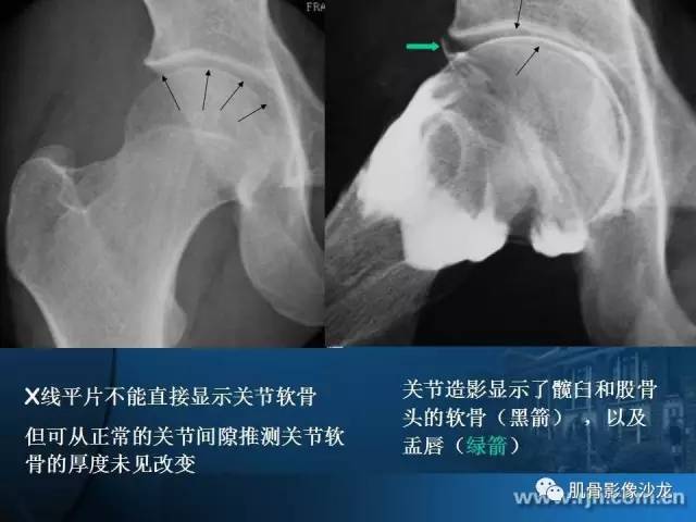【PPT】磁共振软骨成像与骨关节炎治疗评价