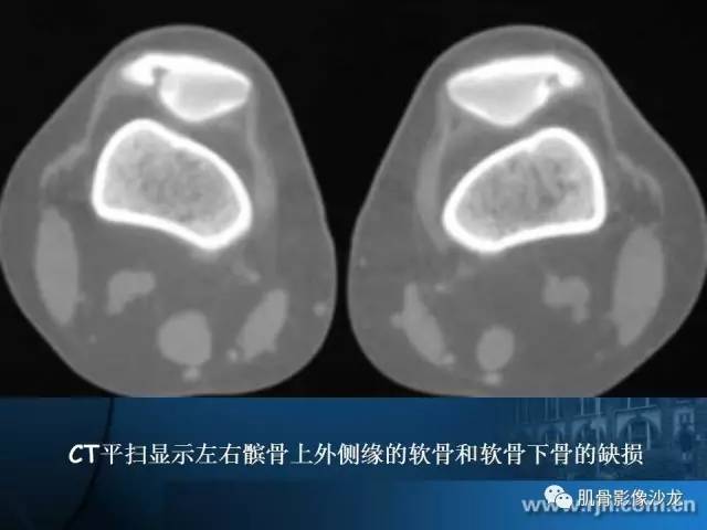 【PPT】磁共振软骨成像与骨关节炎治疗评价