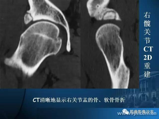 【PPT】磁共振软骨成像与骨关节炎治疗评价