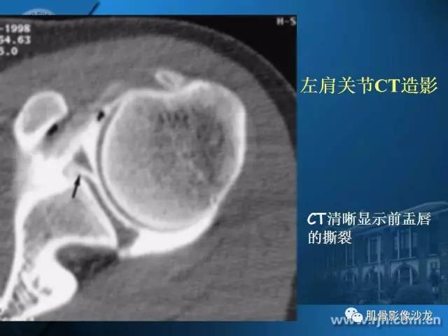 【PPT】磁共振软骨成像与骨关节炎治疗评价