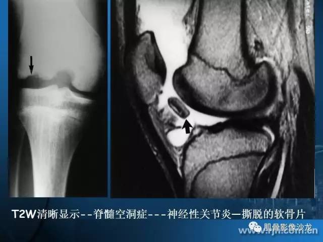 【PPT】磁共振软骨成像与骨关节炎治疗评价