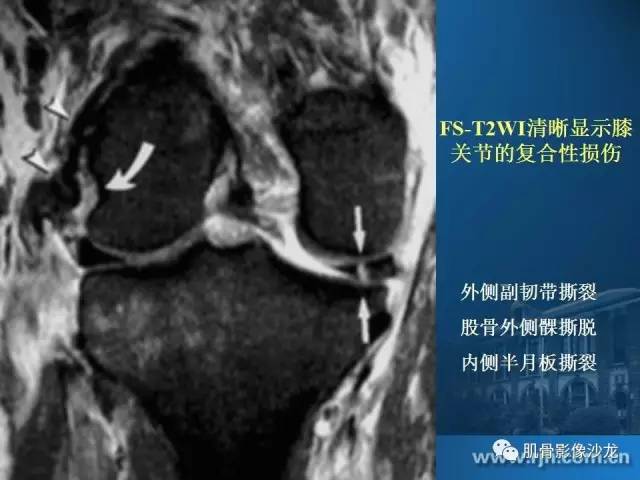 【PPT】磁共振软骨成像与骨关节炎治疗评价