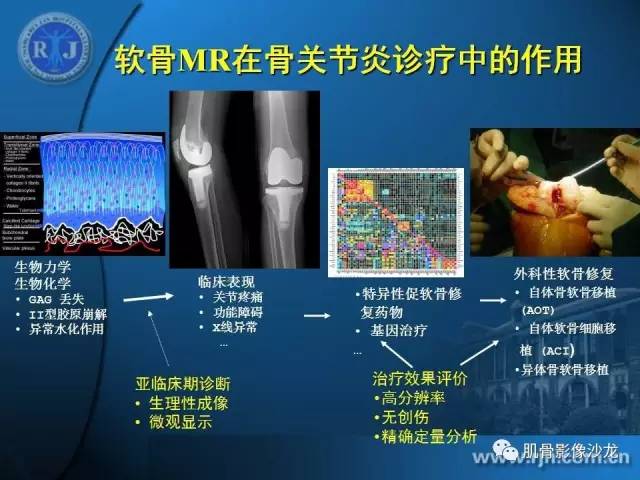 【PPT】磁共振软骨成像与骨关节炎治疗评价