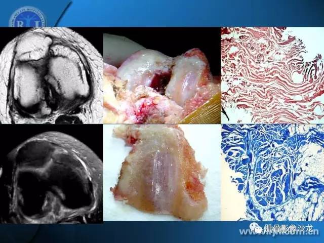 【PPT】磁共振软骨成像与骨关节炎治疗评价