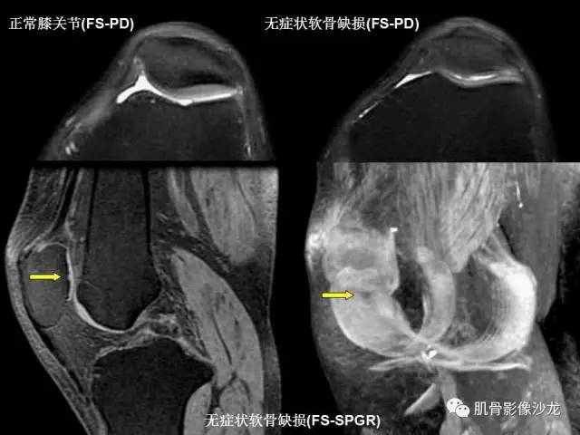 【PPT】磁共振软骨成像与骨关节炎治疗评价