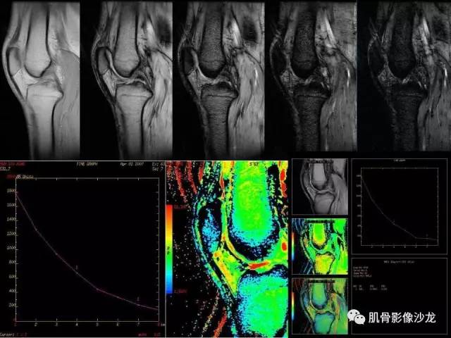 【PPT】磁共振软骨成像与骨关节炎治疗评价