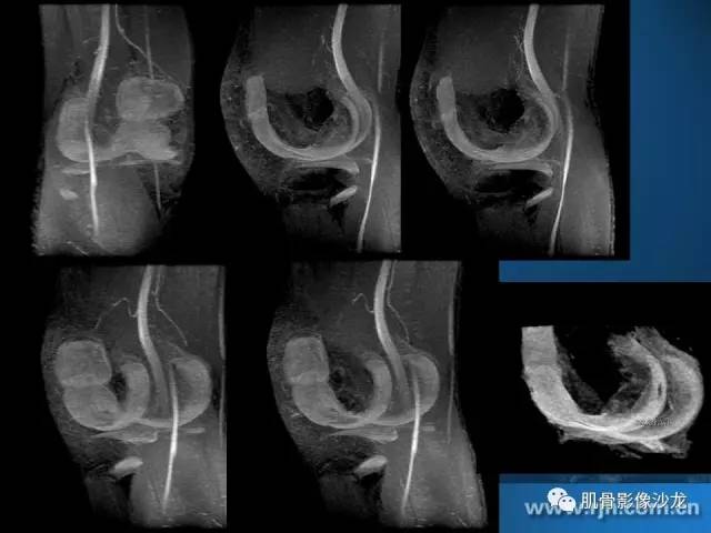 【PPT】磁共振软骨成像与骨关节炎治疗评价