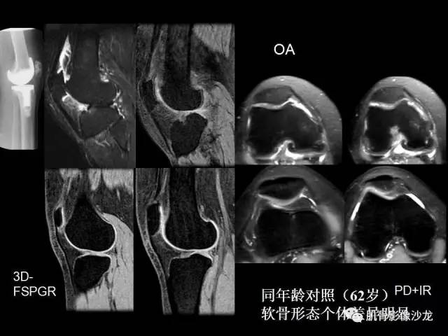 【PPT】磁共振软骨成像与骨关节炎治疗评价