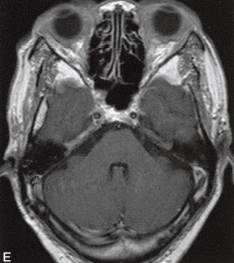 【病例】眼眶淋巴瘤1例MR影像表现分析 【病例】眼眶淋巴瘤1例MR影像表现分析
