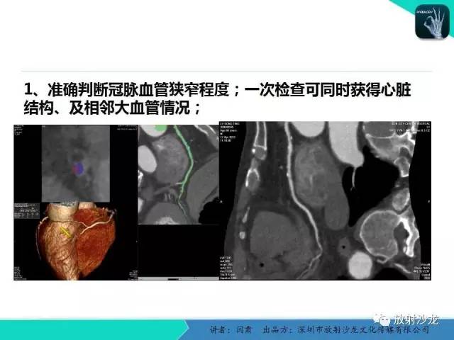 【PPT】冠脉CT与临床