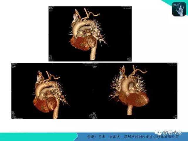 【PPT】冠脉CT与临床