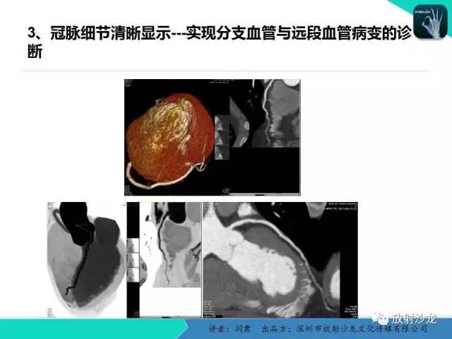 【PPT】冠脉CT与临床