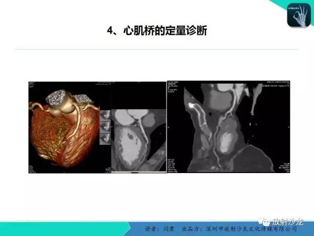 【PPT】冠脉CT与临床