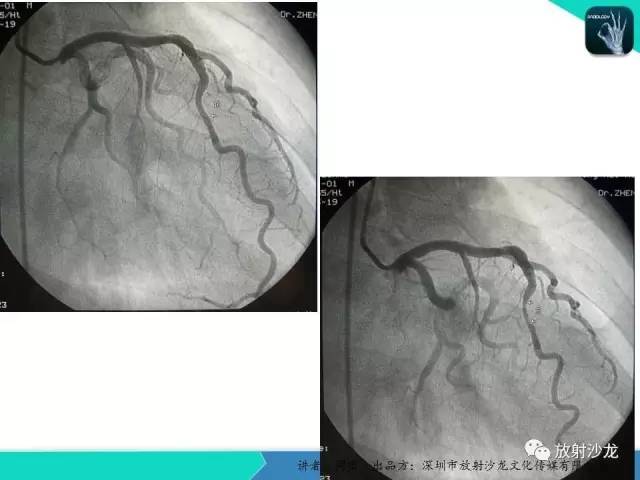 【PPT】冠脉CT与临床
