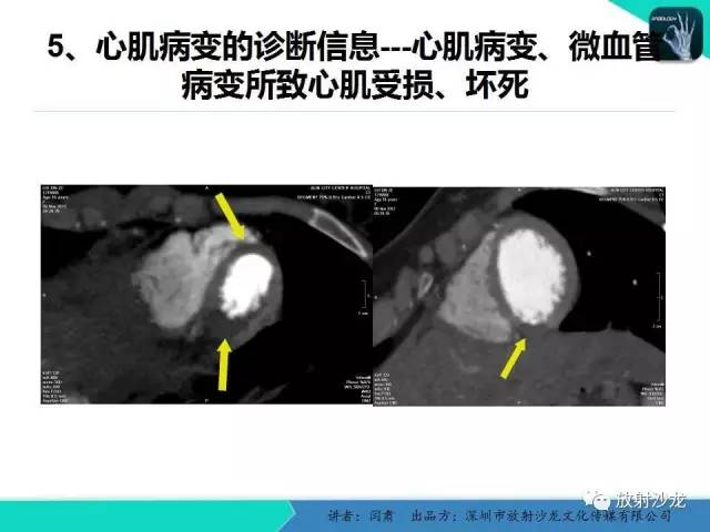 【PPT】冠脉CT与临床