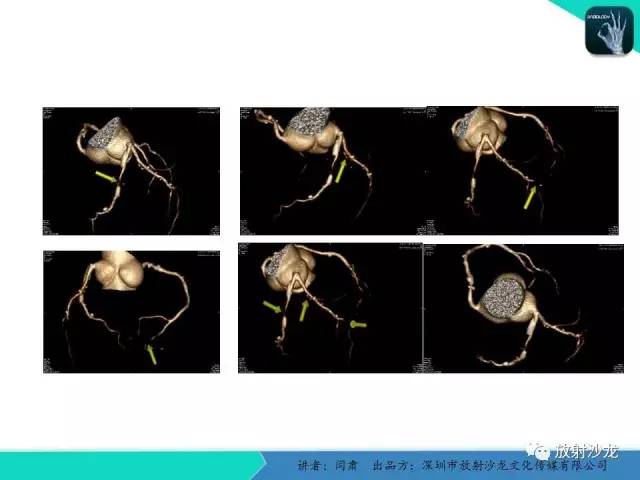 【PPT】冠脉CT与临床