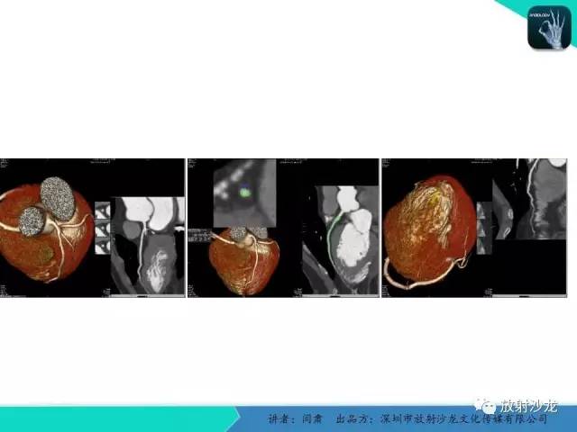 【PPT】冠脉CT与临床