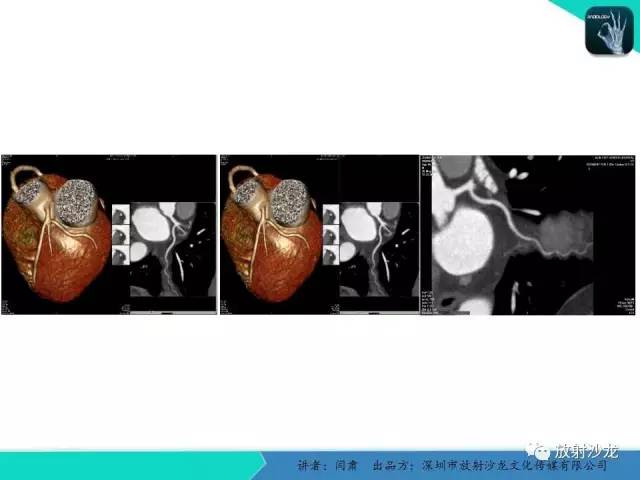 【PPT】冠脉CT与临床
