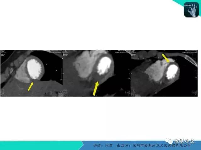 【PPT】冠脉CT与临床