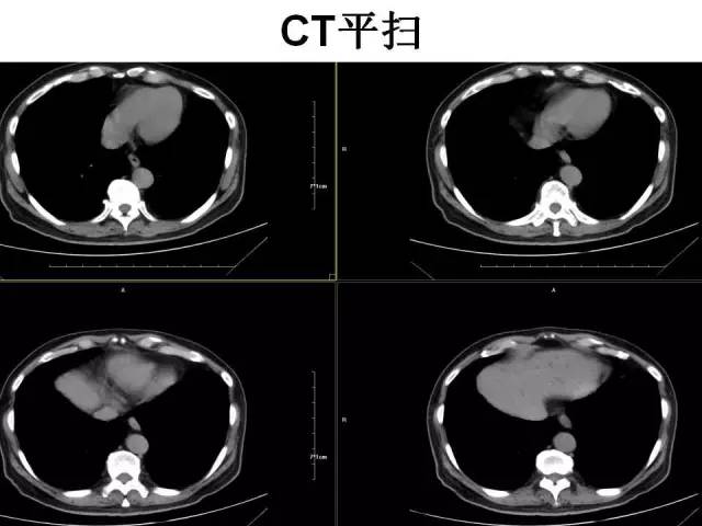 【病例】胆囊腺癌1例CT影像表现 【病例】胆囊腺癌1例CT影像表现