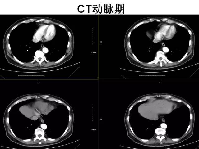 【病例】胆囊腺癌1例CT影像表现 【病例】胆囊腺癌1例CT影像表现