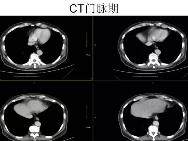 【病例】胆囊腺癌1例CT影像表现 【病例】胆囊腺癌1例CT影像表现