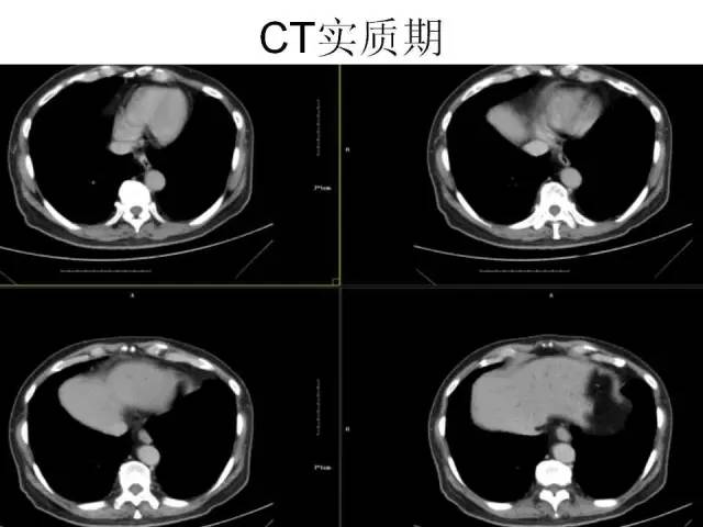 【病例】胆囊腺癌1例CT影像表现 【病例】胆囊腺癌1例CT影像表现