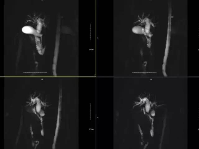 【病例】胆囊腺癌1例CT影像表现 【病例】胆囊腺癌1例CT影像表现
