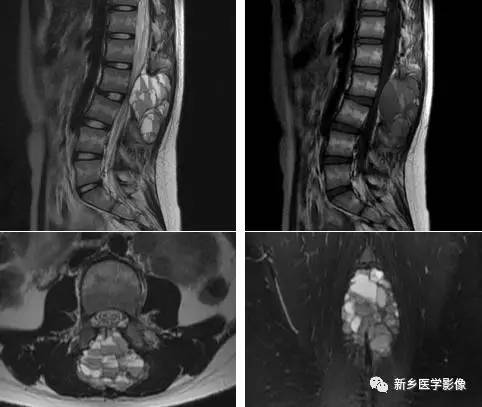 在椎体附件的8种肿瘤,您掌握了吗? 在椎体附件的8种肿瘤,您掌握了吗?