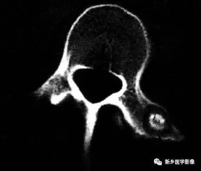 在椎体附件的8种肿瘤,您掌握了吗? 在椎体附件的8种肿瘤,您掌握了吗?